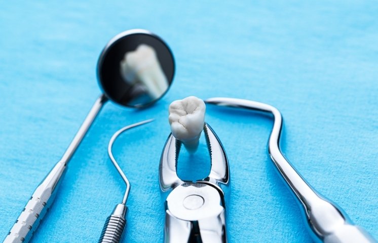 common reasons for tooth extraction